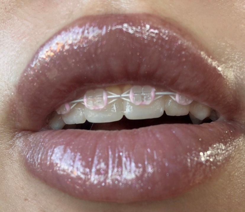 🩷 rate my braces
